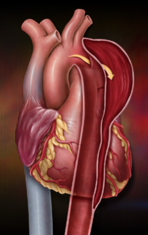 Aortic Dissections are Like Snowflakes